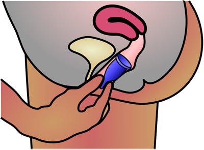 https://commons.wikimedia.org/wiki/File:Menstrual_cup_insertion.svg